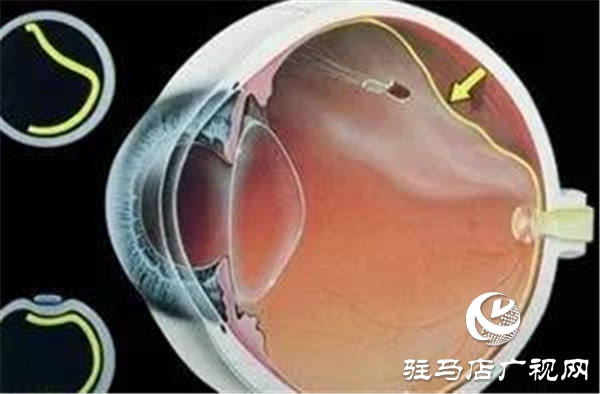 一只眼睛視網(wǎng)膜脫落，另一只也會(huì)脫落嗎